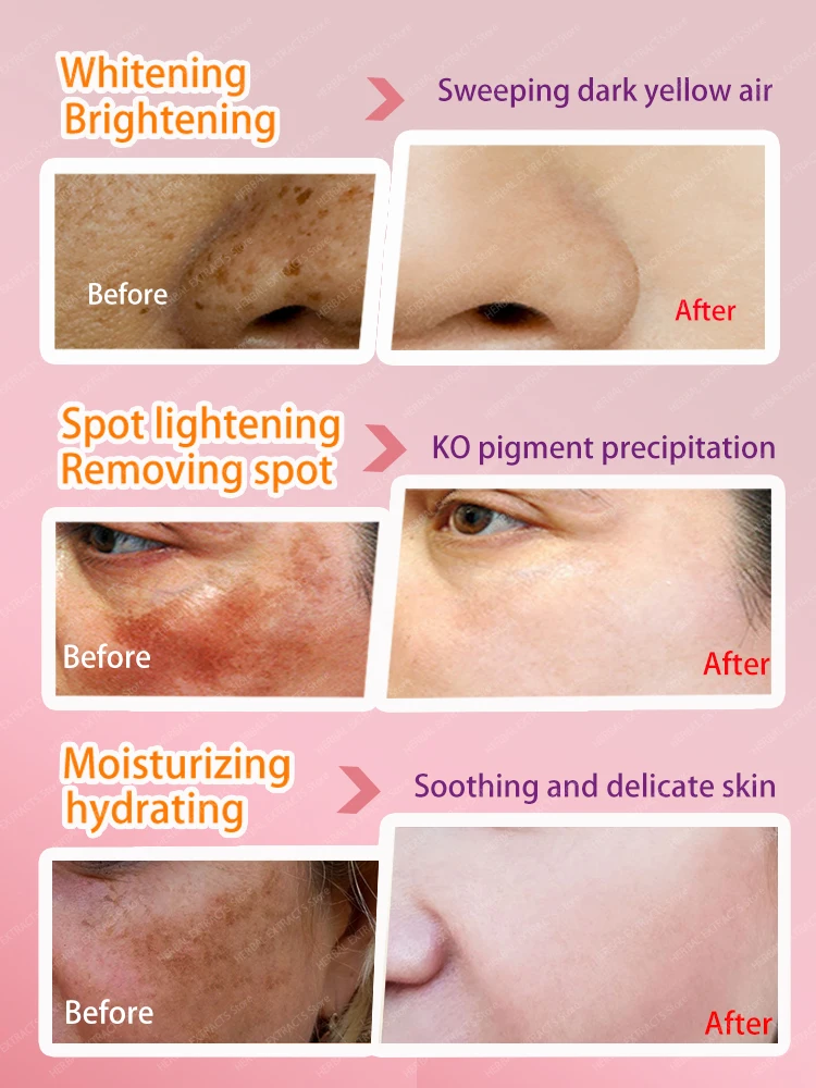 Freckles sun age Dark Spot For Face