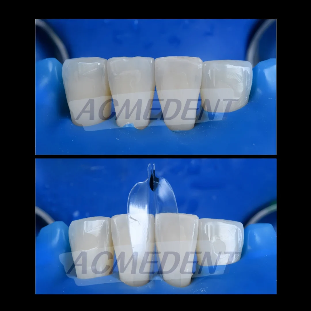 S1 Dental Transparent Matrix Clear Matrix BT Bow Maxillary Matrices Contoured Similar with BioClear Matrice Black Triangle