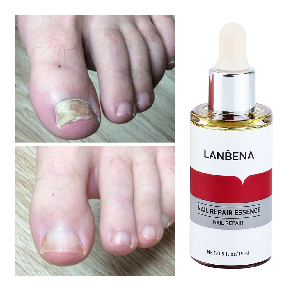 LANBENA 15ml Nail Repair Essence Serum Anti Infection Paronychia Onychomycosis Treatment Foot Care Nail Fungus Removal Gel