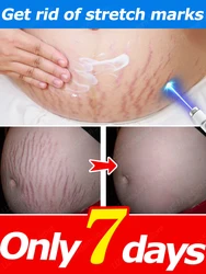 Stretch Mark Cream Reduces Scar Lncrease Skin Elasticity Smoothes Firms