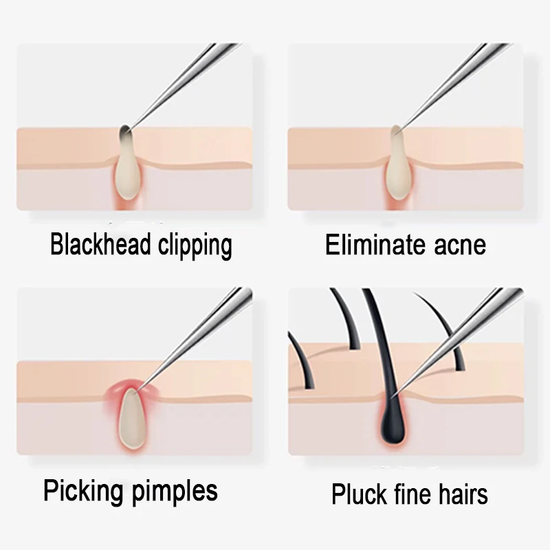 4-5pcs Acne Ago Pinzette per punti neri Aghi per rimozione punti neri Pulito Viso Cura della pelle Ago detergente Strumento per la rimozione delle imperfezioni LB20