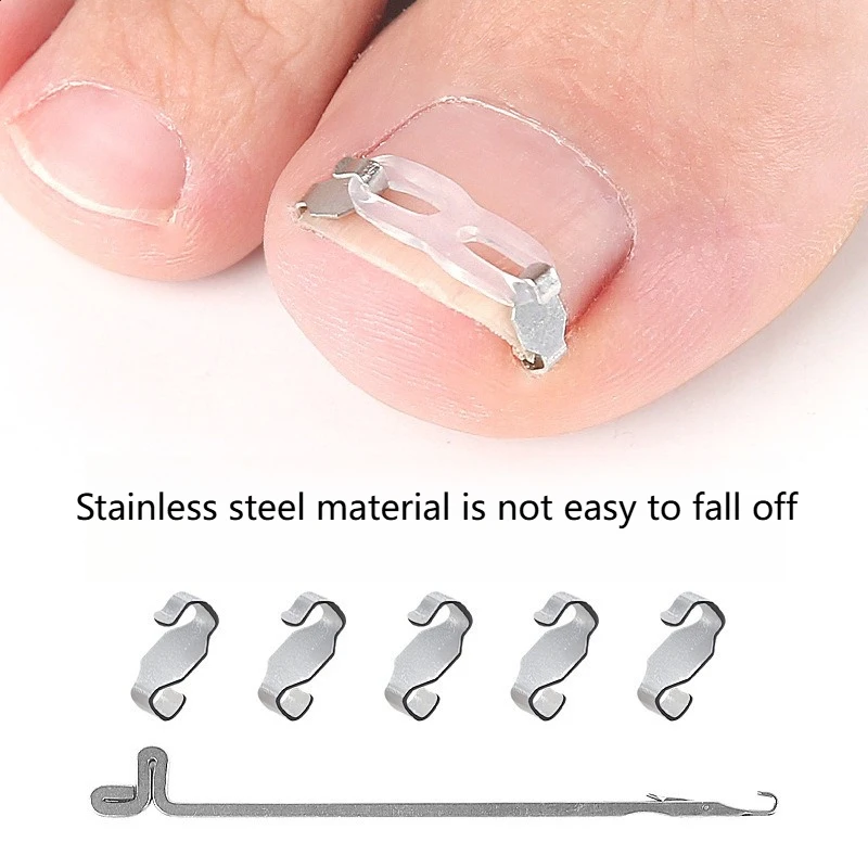 1/2 conjunto de ferramentas corretoras de unhas encravadas, pedicure, recuperação, tratamento de unhas, kit de reabastecimento de unhas, ferramenta de correção de cuidados com os pés