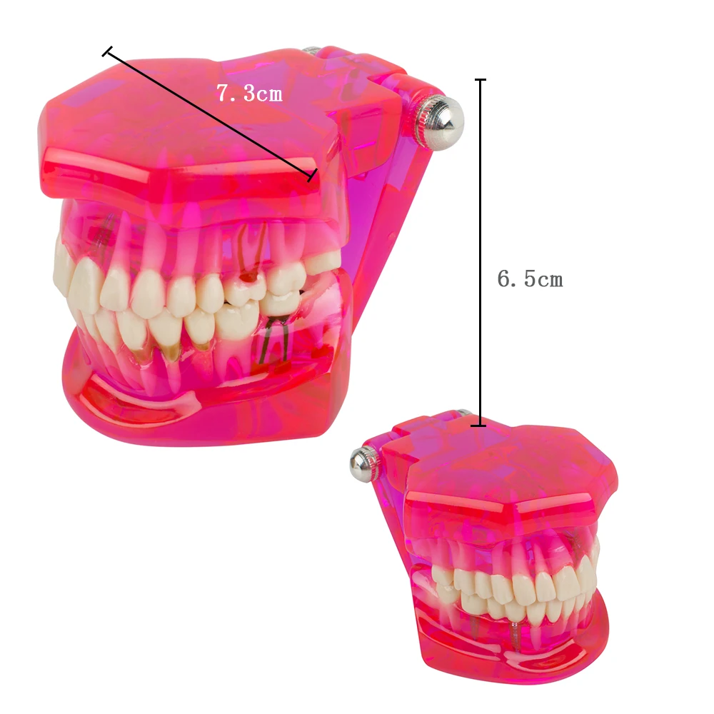 Verbeter Uw Tandheelkundige Opleiding Met Fda Ce-Goedgekeurde Tandenmodel Voor Implantaatherstel En Pathologiestudie-Ideaal Voor Tandheelkundige