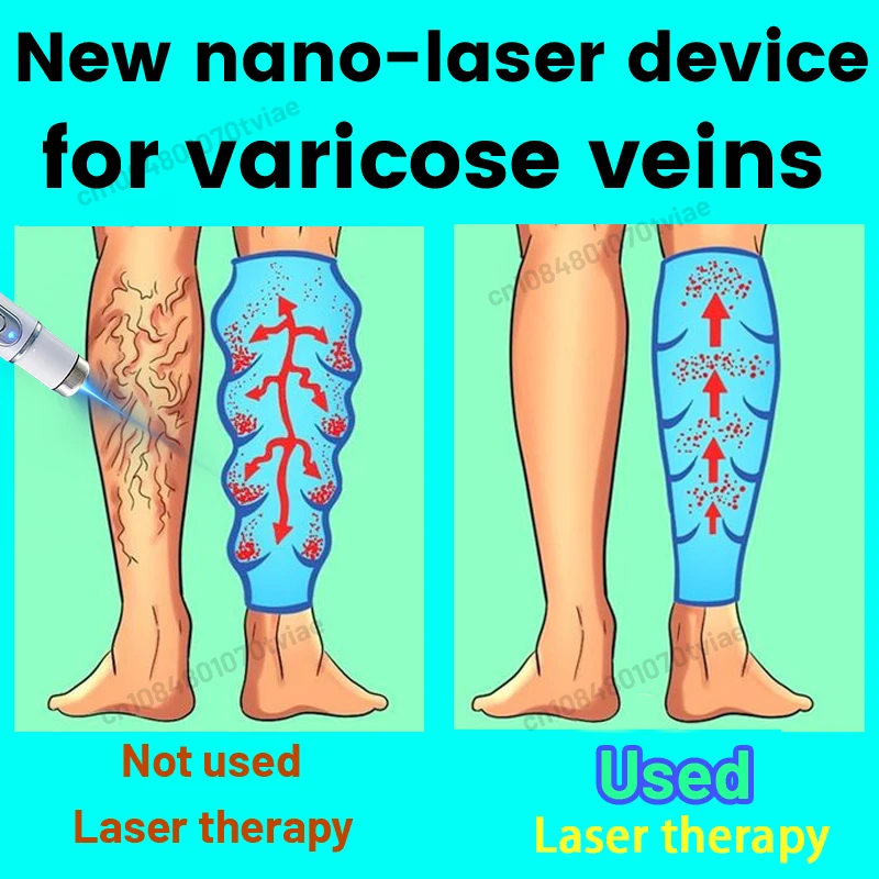 

The instrument focuses on solving one problem: varicose veins