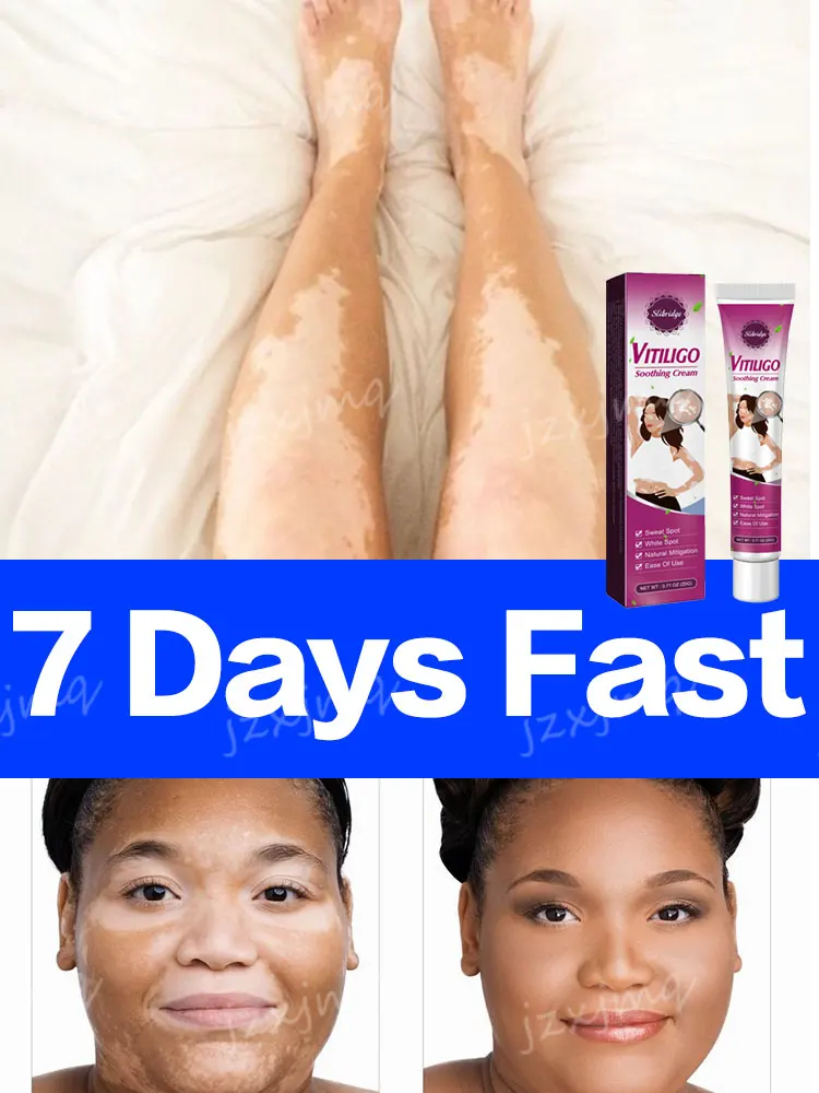 

Vitiligo Ointment Effectively Improvement White Spot Skin Eliminate