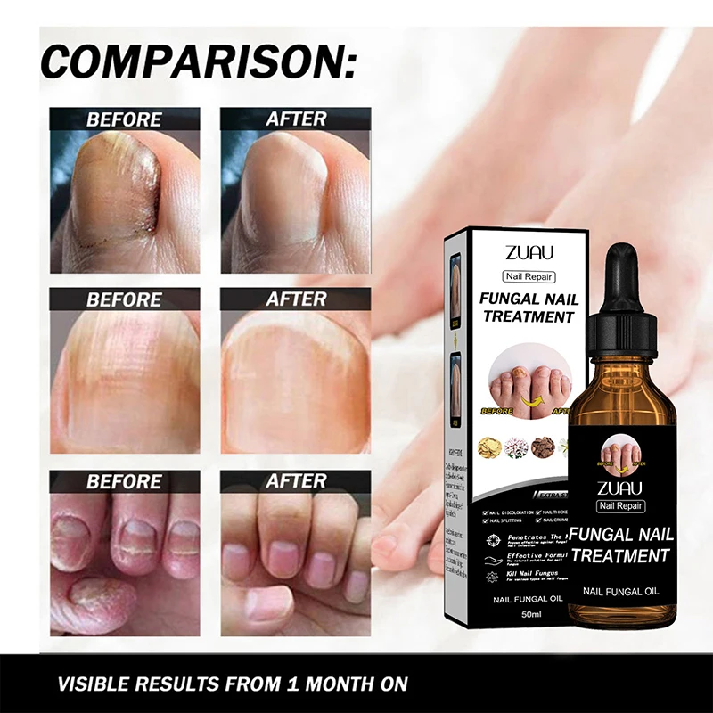 Nail Fungals Renewal Nail Repair Liquid for Discolored Thickened Crumbled Nails Nail Fungals for Discolored Broken Cracked