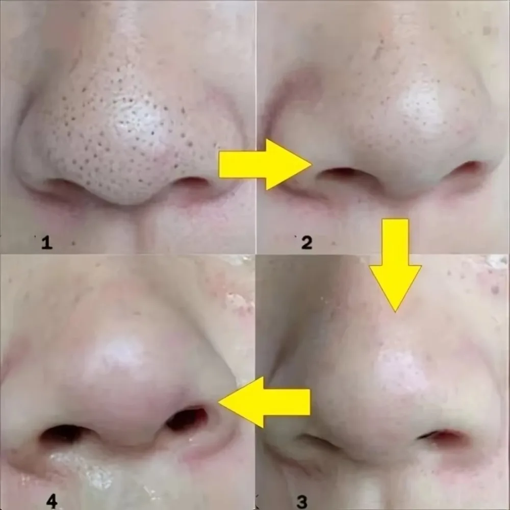 20PCS Bamboo Charcoal Blackhead Stickers Nose Deep Cleansing Remove Blackheads Nose Film Care Skin Adsorb Oil Black Dots Strips