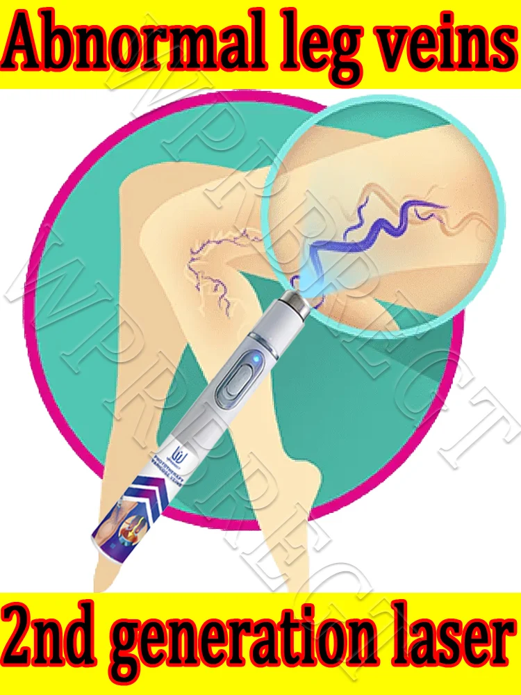 

The second generation blue light laser pen effectively relieves leg dilated vasculitis and eliminates varicose veins, and can he
