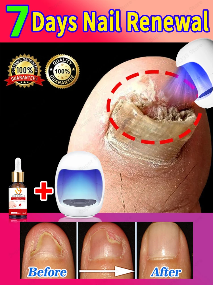 

Laser For Solving Feet Nail