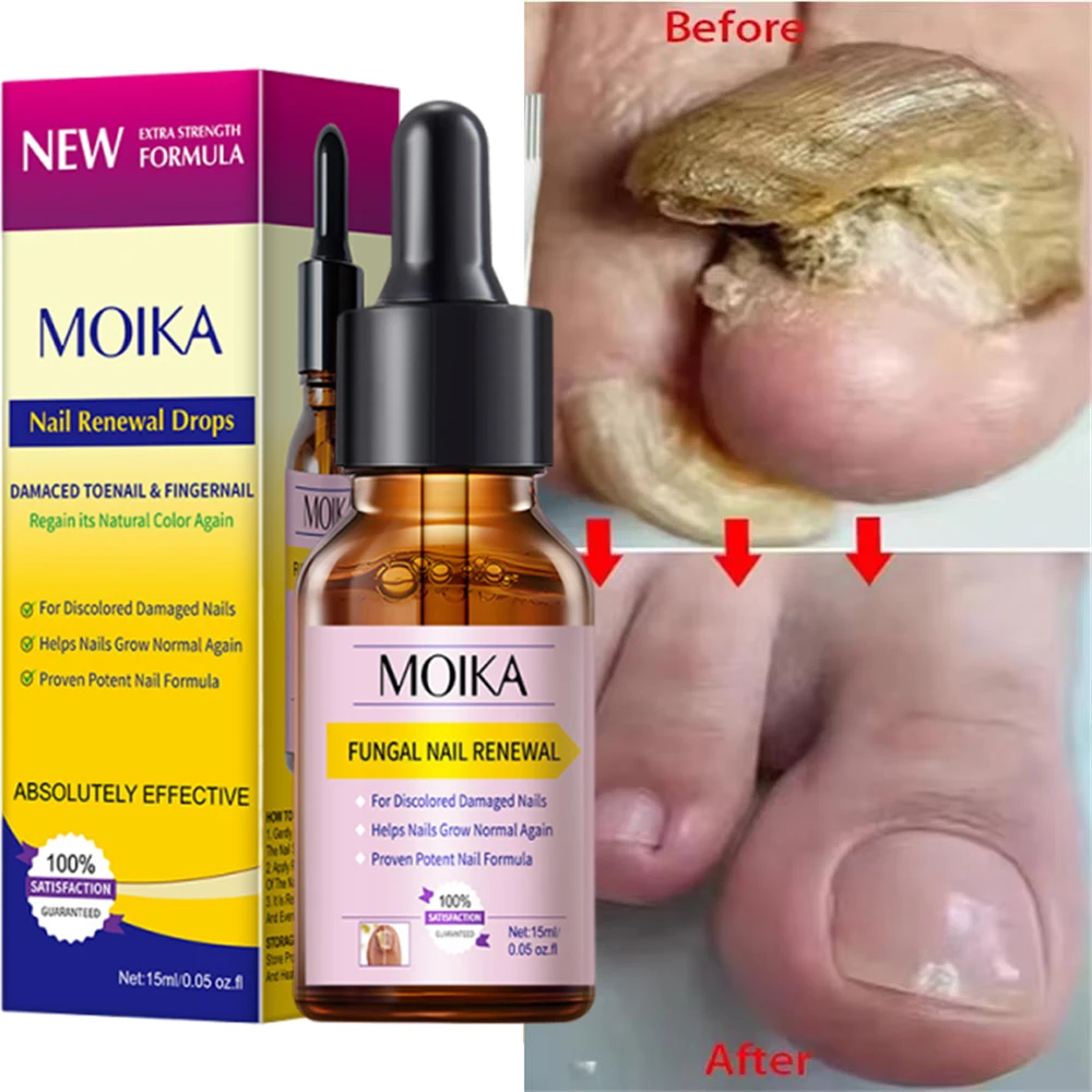 جديد علاج الأظافر الفطرية مصل القدم فطريات الأظافر إزالة إصلاح هلام مكافحة العدوى الداحس فطار الأظافر الرعاية جوهر