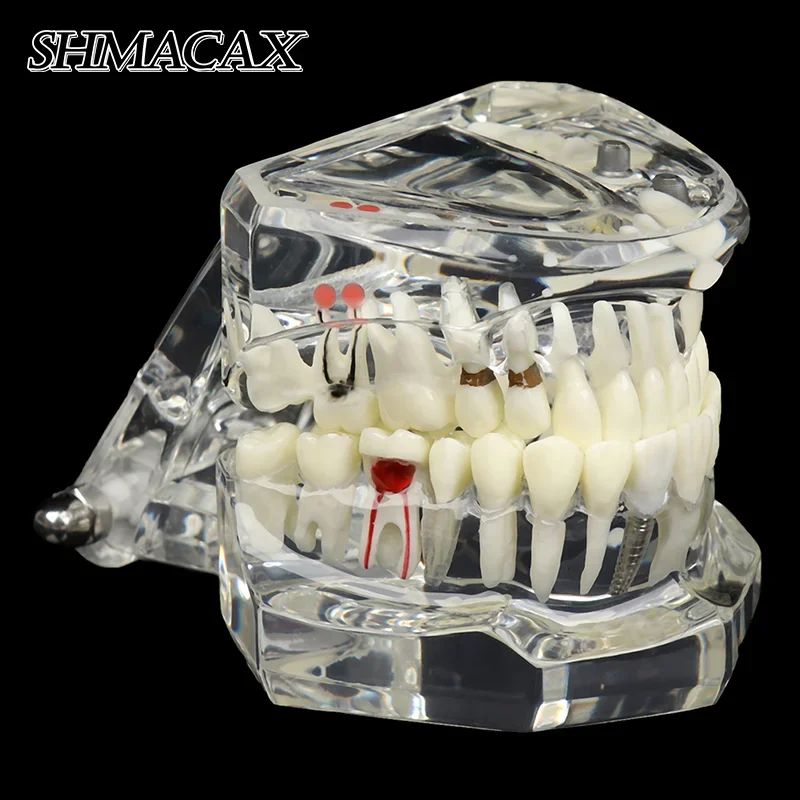 1pc Dental Model Teeth Implant Restoration Bridge Teaching for Study Tooth Science