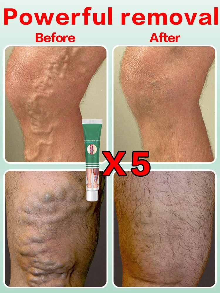 ointment for varicose veins Effective varicose vein relief cream to relieve vasculitis phlebitis spider pain treatment