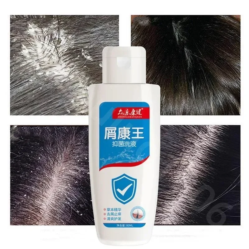 

Natural Shampoo Anti Dandruff Shampoo Fast Get Rid of Anti Dandruff Hair Loss Scalp Cleaning Dandruff Repair Health Care