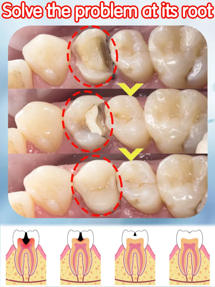 Solve cárie e problema de cárie dentária