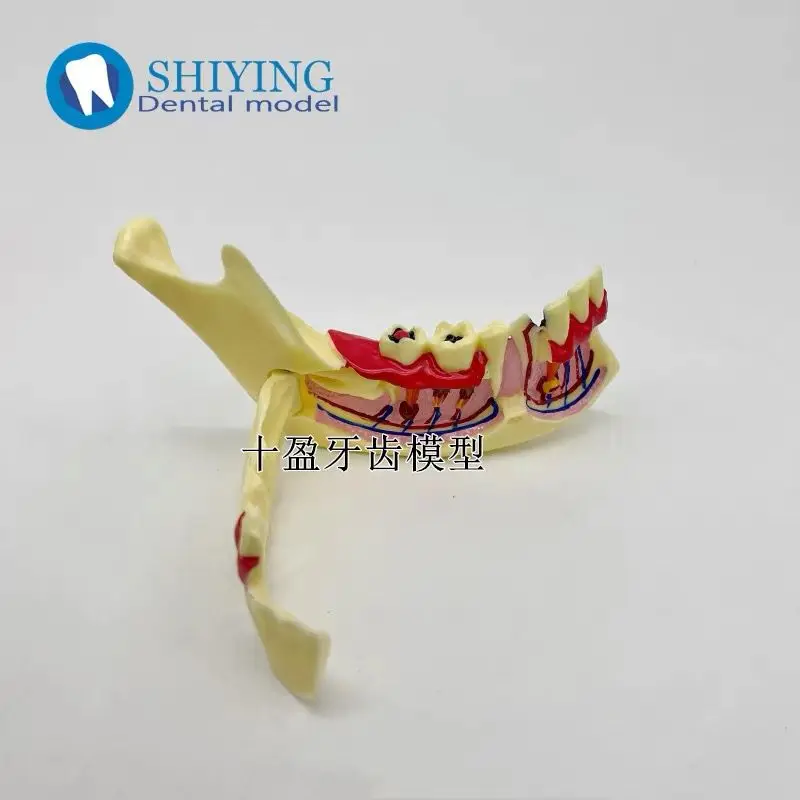 Dental Oral Teaching Model Caries Development Demonstration Crystal Adult Pathological Model Dental Anatomy Display