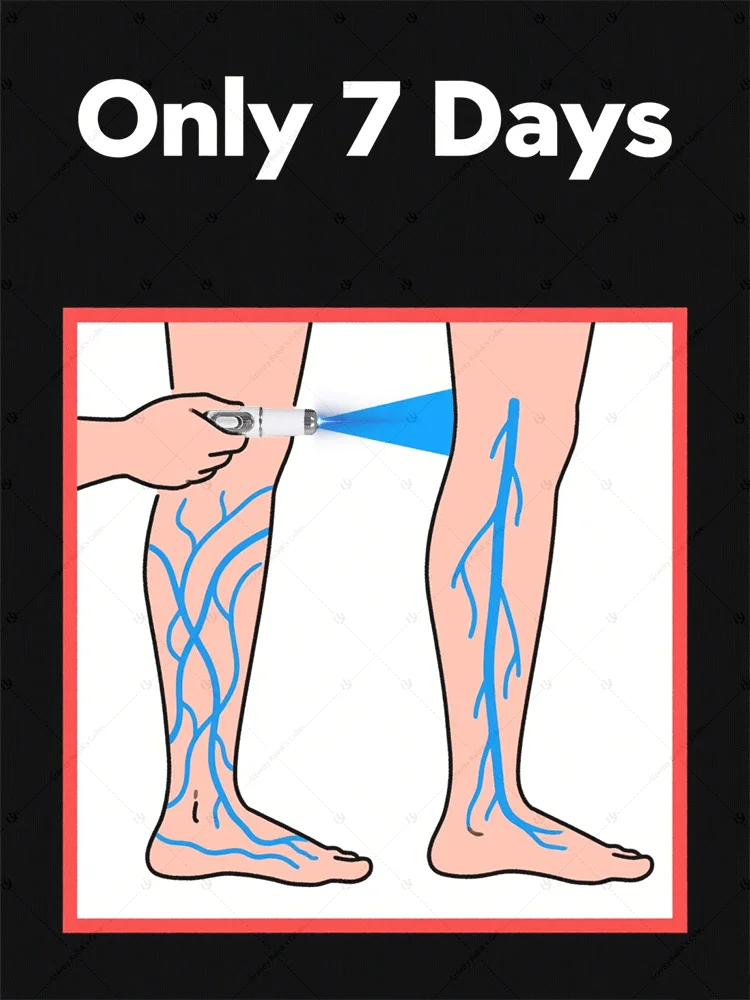 

hot sale leg care tools，blue light pen solve varicose veins