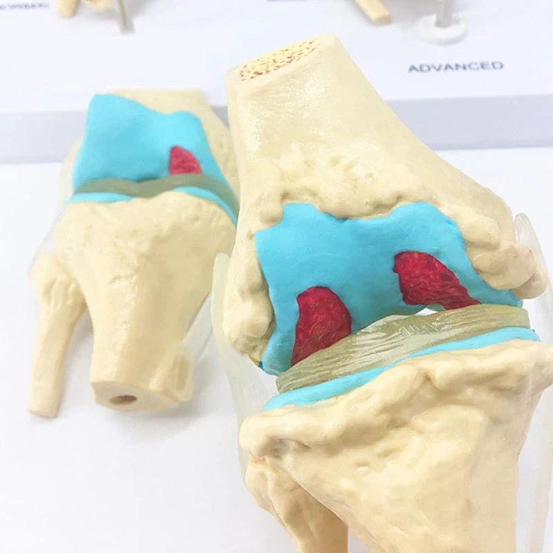 Four-stage Human Pathological Knee Joint Anatomy Model Medical Science Teaching Resources Dropshipping