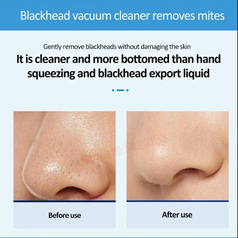 Nose Blackhead Peeling Solution Serum Facial Cleaning Liquid Scrub Special Solution Skin Deep Cleaning For Small Bubble