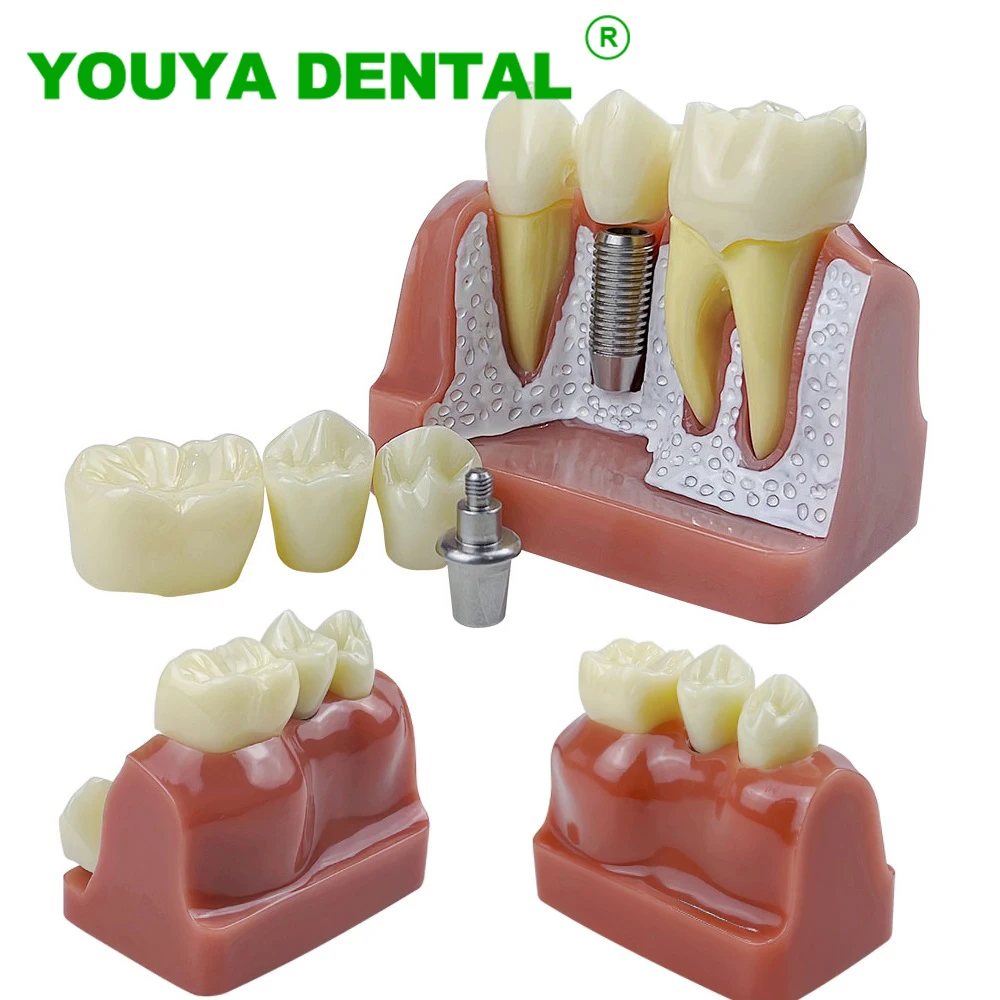 Dental Teeth Model 4 Times Implant Analysis Crown Bridge Removable Model Dentist Student Teaching Training Demonstration Tools