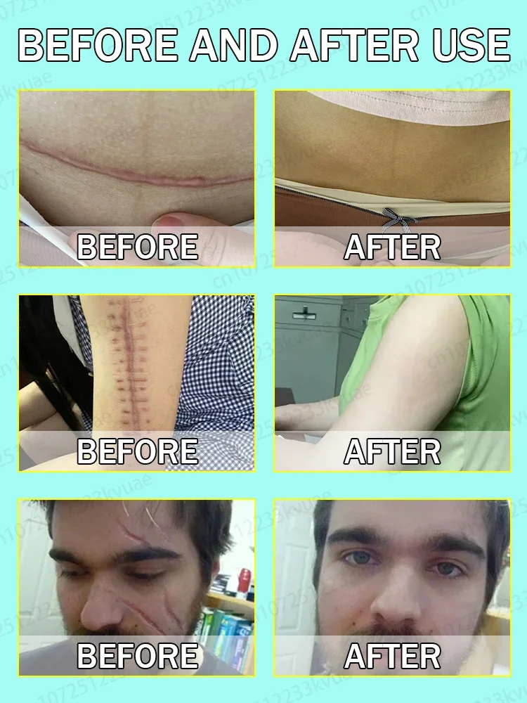 Der Arzt empfiehlt schnelle Ergebnisse |   Tragbarer Laserstift zur tiefen Reparatur und Narbenentfernung zu Hause