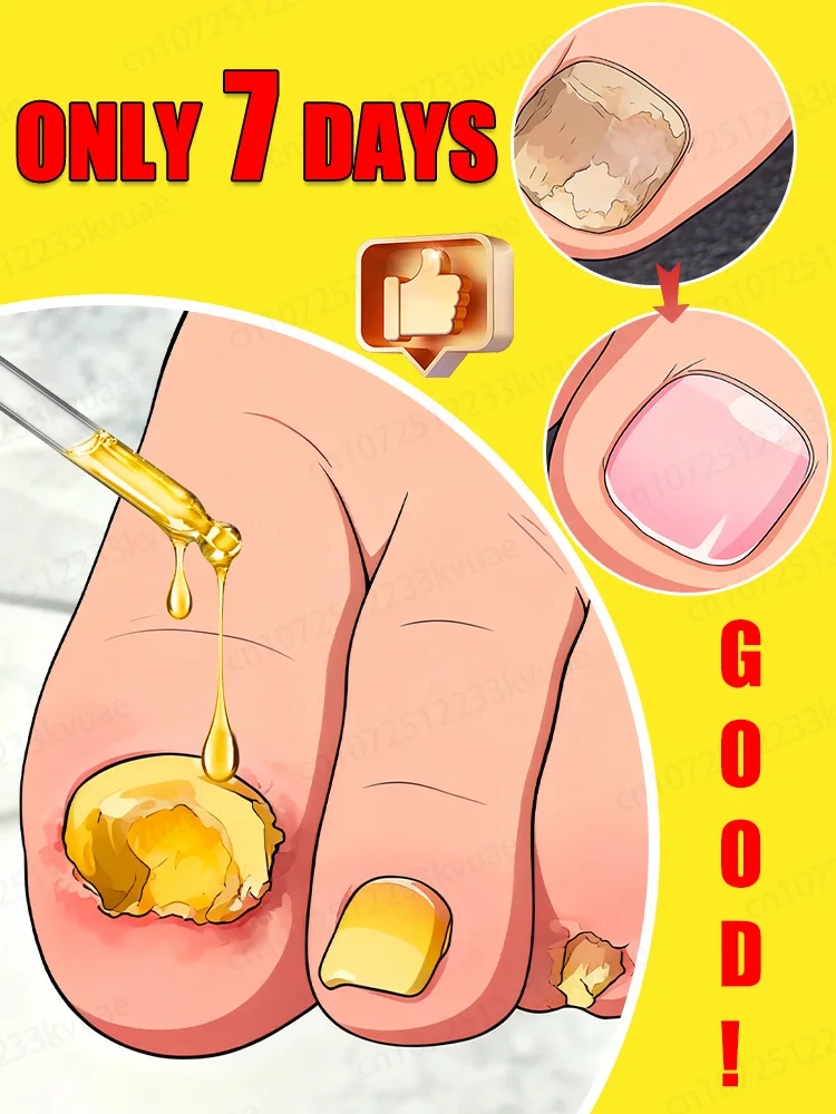 

Tᴏᴇɴᴀɪʟ Fᴜɴɢᴜs Pᴀᴛᴄʜᴇs Rᴇᴘᴀɪʀ Dɪsᴄᴏʟᴏʀᴇᴅ Dᴀᴍᴀɢᴇᴅ Nᴀɪʟs Fᴏᴏᴛ Cᴀʀᴇ