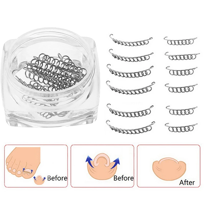 12 قطعة من مثبت الأسلاك لتصحيح أظافر القدم الغارزة - أداة العناية بالقدم والباديكير لاستعادة أظافر القدم #2