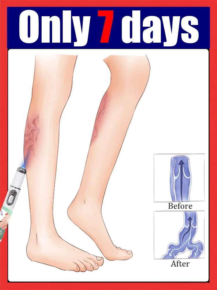 caneta de luz azul resolve varizes, mais descontos em conjuntos de ferramentas para cuidados com as pernas diga adeus às varizes