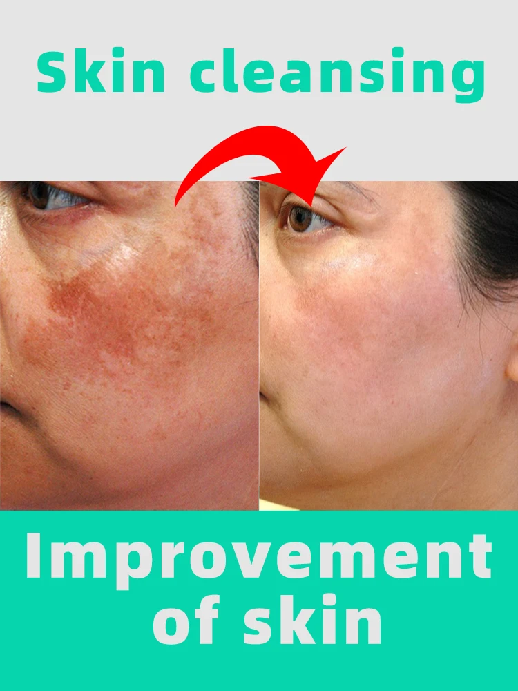 

Dark Spot Remover For Face Freckles Melasma