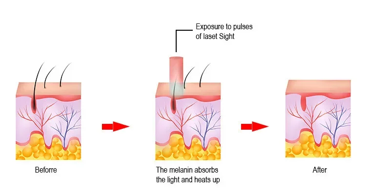 Nuovo Design Mini raffreddamento ad aria Opt Laser dispositivo di depilazione permanente ringiovanimento della pelle Ice Cool Skin Cooling Machine