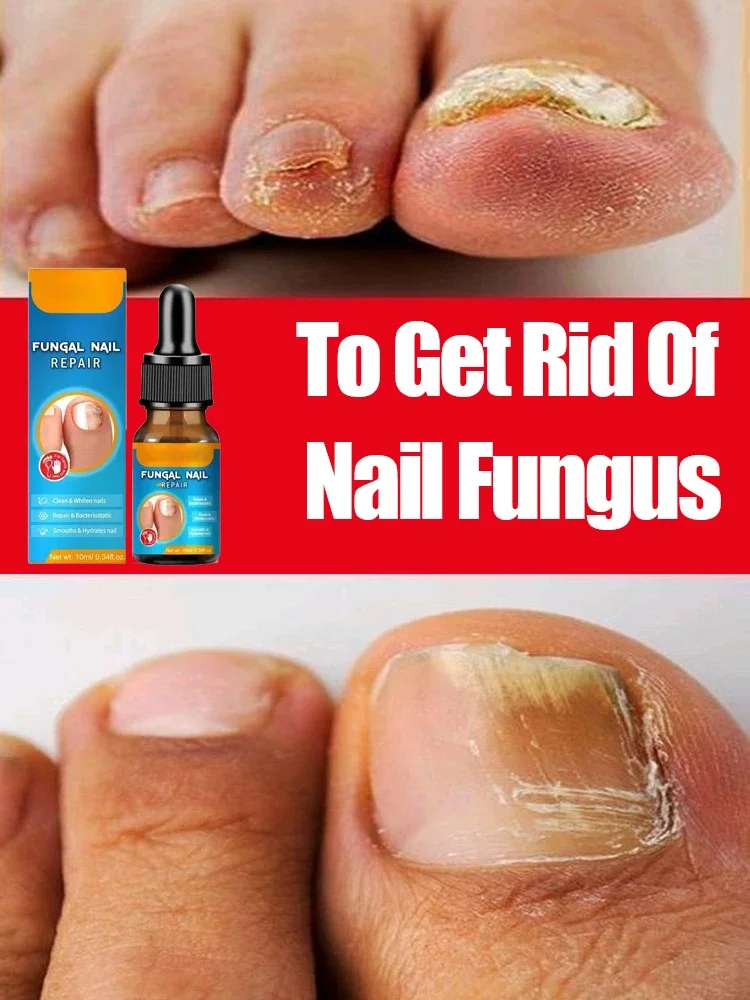 

Nail Fungal Treatment Serum Onychomycosis Paronychia Anti Infection Toe Fungus Hand Foot Removal Repair Gel Care Beauty Health