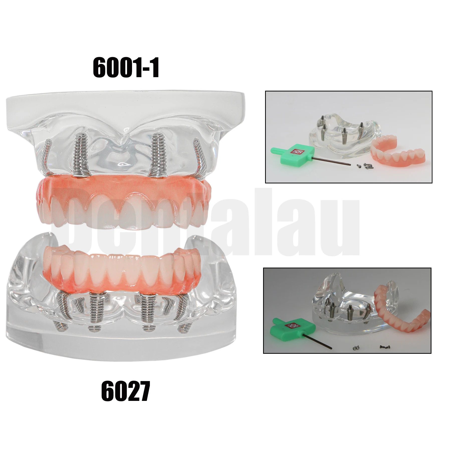 Dental Implant Typodont Teeth Overdenture Restoration Teeth Model Upper/Lower Jaw Type With 4 Screws M6001-1 M6027