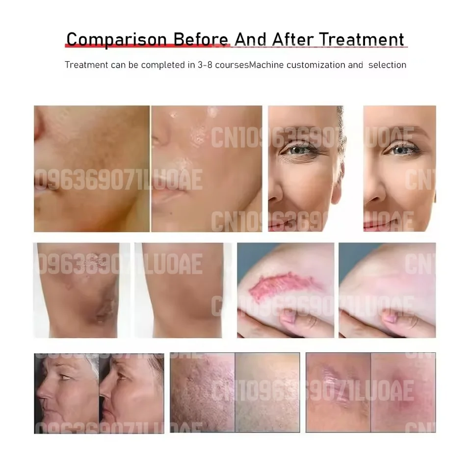 10D Laser Fat Reduction Machine - 532nm Green & Red Light - Painless Fat Loss, Skin Tightening - Hot Sale