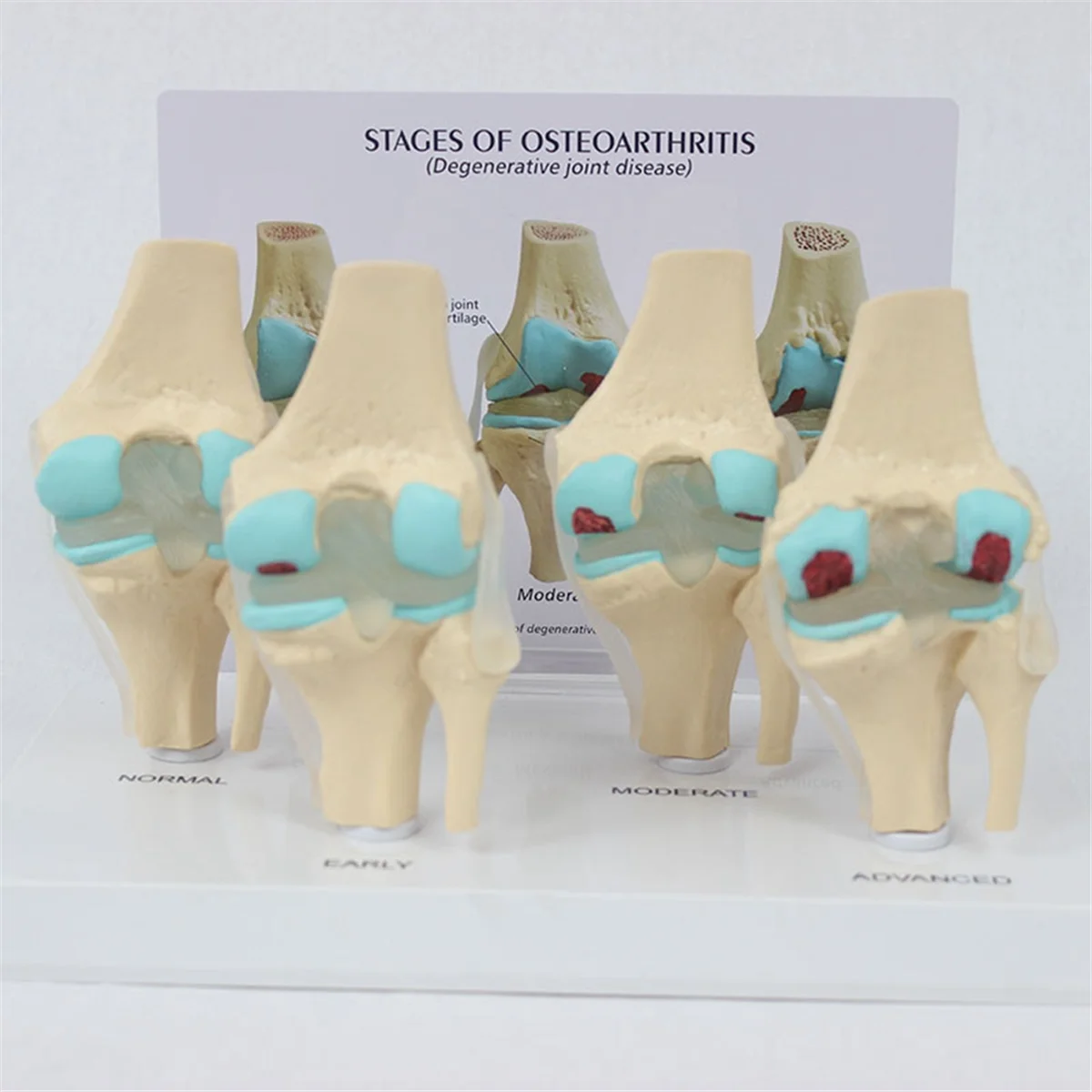 Zestaw do kolan choroba zwyrodnieniowa stawów Model anatomiczny z karta klucz edukacyjnym 4-stopniowy Model kolana pomoce nauczycielskie ortopedyczny