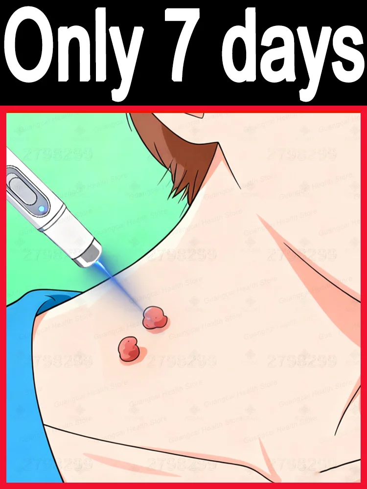 

Laser pen wart removal without ʷᵒʳʳʸⁱⁿᵍ ᵃᵇᵒᵘᵗ ⁱⁿᶠᵉᶜᵗⁱᵒⁿ ᵒʳ ⁱⁿᶠˡᵃᵐᵐᵃᵗⁱᵒⁿ