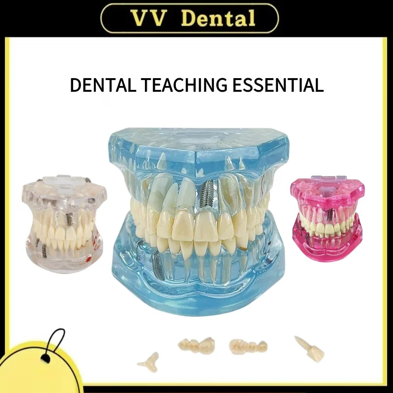 

Standard Dental Teeth Model Implant Disease Dentist Studying Demo Dental Typodont Model With Removable Teeth Restoration Bridge