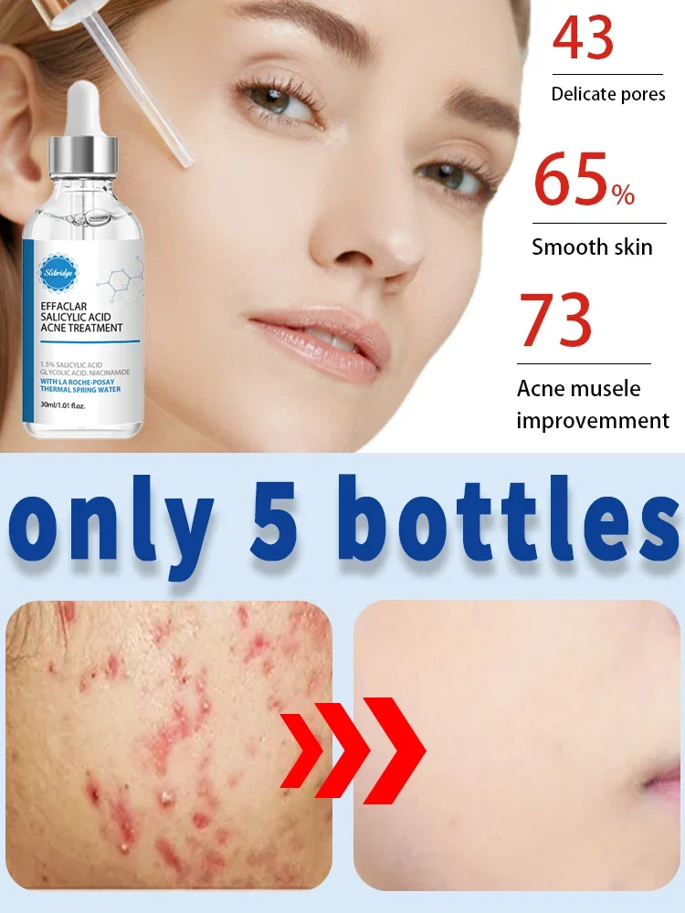 

Acne Treatment Cream For Face Scar Serum Remover Remedy