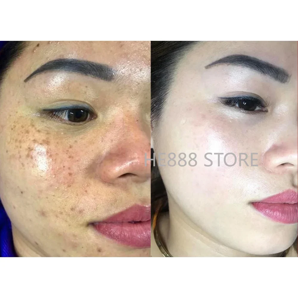 VC Whitening Serum Spot Removal Moisturizing Lightening Melanin Remove Melasma Whitening Brightening Rejuvenating Skin Care