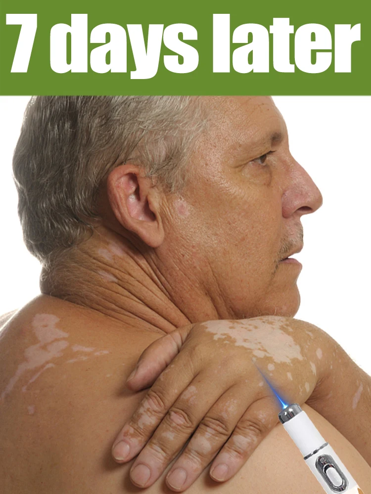 أحدث المنتج هو قلم الضوء الأزرق للبهاق وأداة العناية بالجسم.