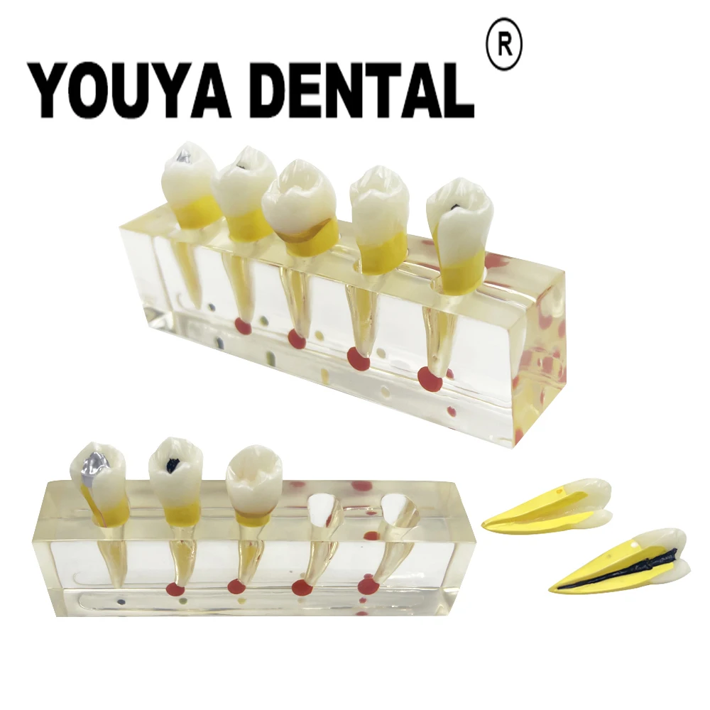 

Removable Dental Pulp Clinical Model Disease Teeth Model for Dental Practice Training Studying Doctor-patient Communication Tool