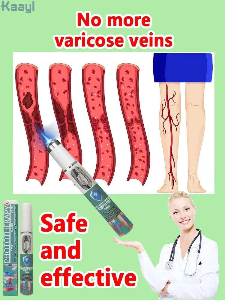 

Varicose vein laser pointer| for Anyone with Sedentary or Standing| Improves Blood Circulation