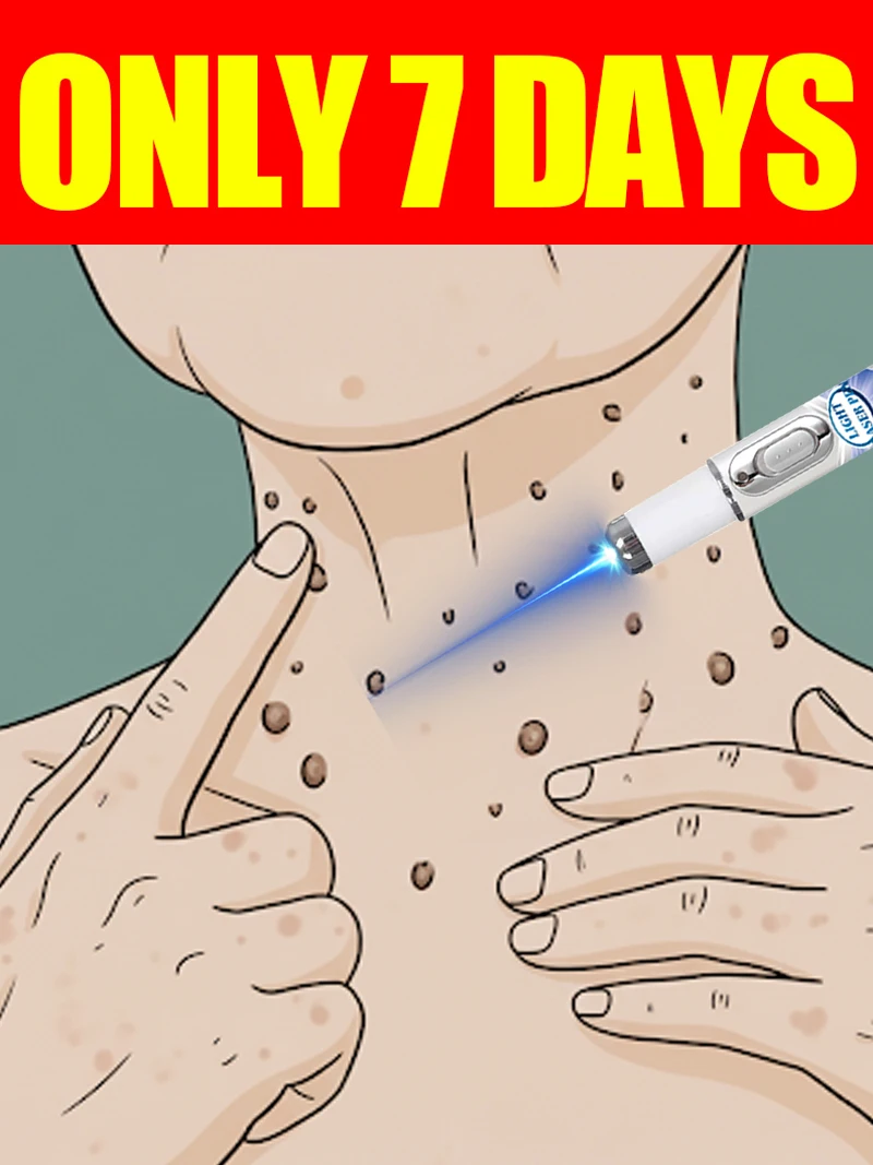 

blue light pen solve Various warts, hot sale wart care tools