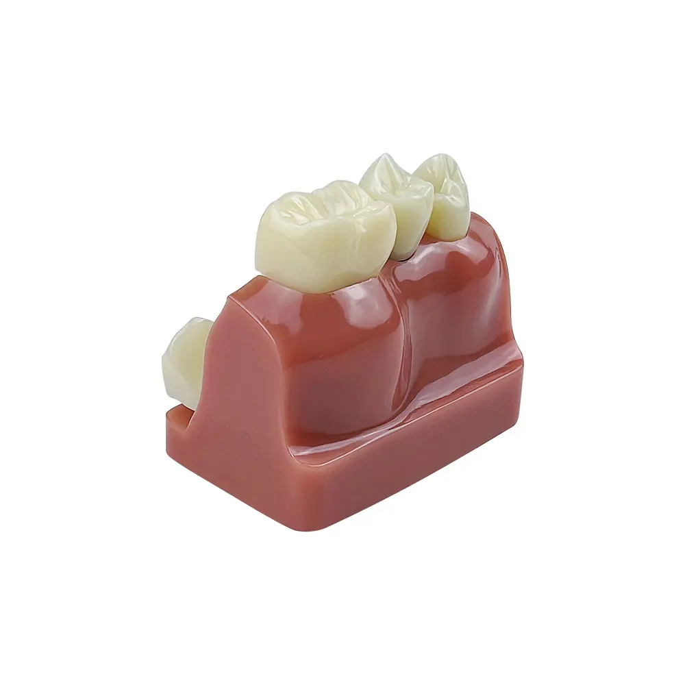 Dental 4 Times Implant Teeth model Dentisty Study Training Teaching Model Analysis Crown Bridge Demonstration Removable Model