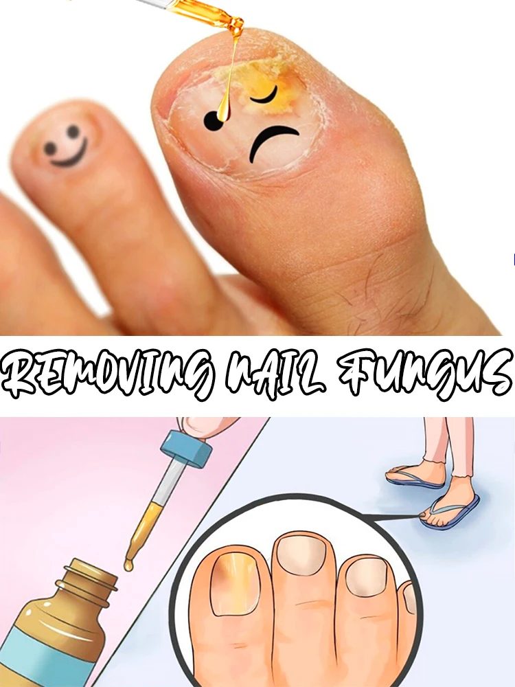 

Onychomycosis Treatment Oil, CE Certified, Gentle Nail Repair, 10g