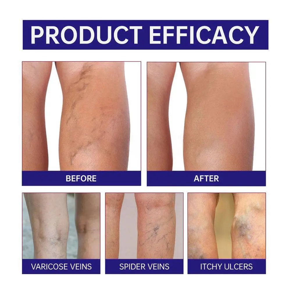 Japan Dongtian Vein Health Cream Vein Relief Cream for Legs Soothes Aching Varicose Veins Alleviates Swelling Deep Nourishment - view 5
