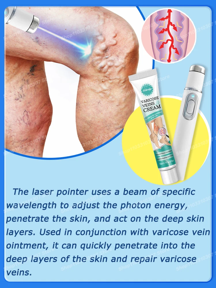 Laser crema varicose