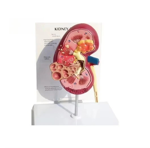 Medic Anatomy Pathological Research Models High-quality Kidney Pathological Models and Healthy Kidney Models