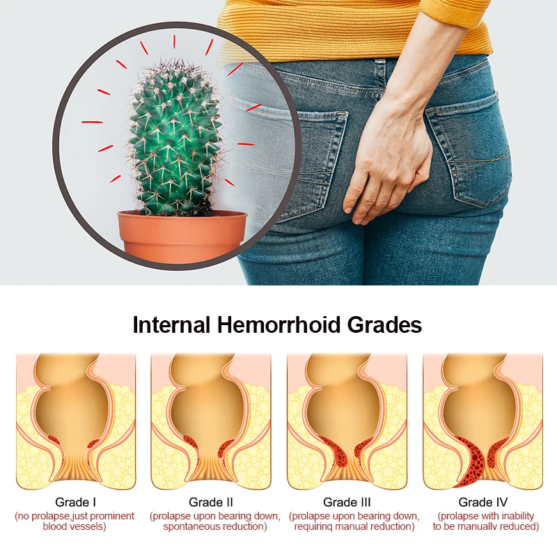 1Pcs Hemorrhoid Cream Remover Internal Piles Herbal Relieve Anal Pain Anus Swelling Bleeding Hemorrhoids Medical Ointment G042