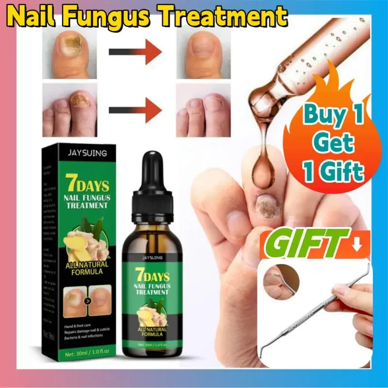 7 Days Nail Fungus Treatments Serum Foot Care Feet Care Essence Anti Infection Onychomycosis Foot Toe Nail Fungus Removal Gel