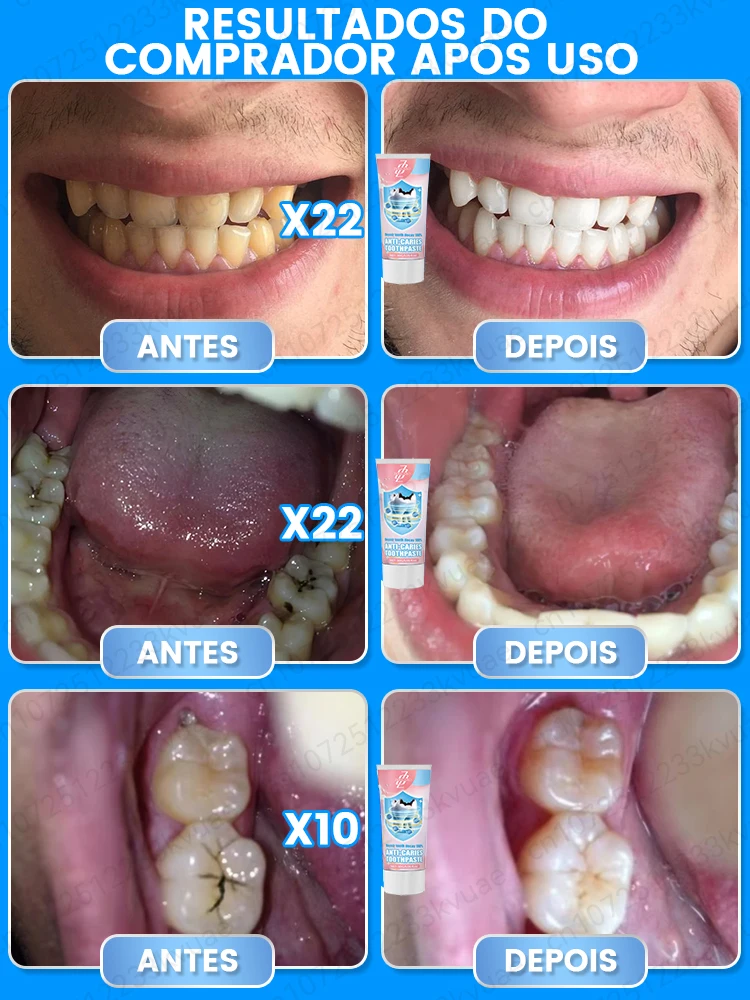 Dentifrice anti-caries reminéralisation dentaire récupération émail réparation renforcement restauration carie protection dentaire dents