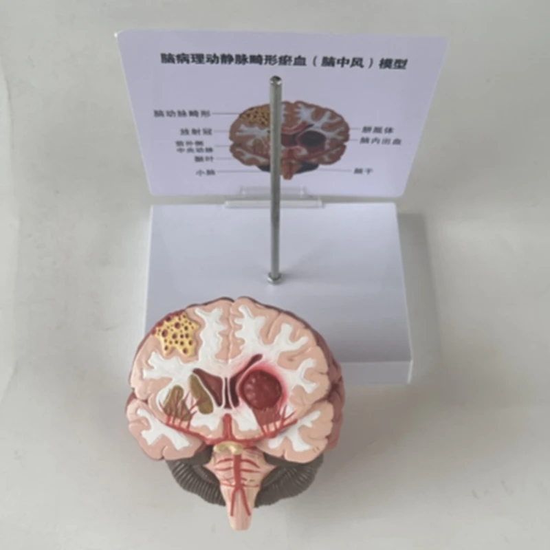 Top-Human Brain Disease Model - Brain Pathology Brainstem Hemorrhage  Teaching Model - Human Brain Anatomy Model